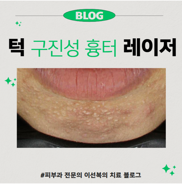 턱 구진성 흉터, 깨끗하게 없애는 방법