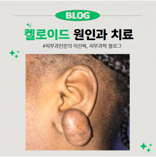 켈로이드에 대한 여러 질문들