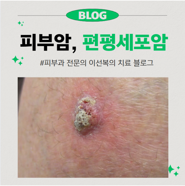 피부에 발생하는 암_편평세포암