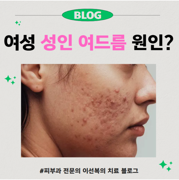 여드름 과연 원인이 무엇일까?-성인 여성 여드름 논문 고찰
